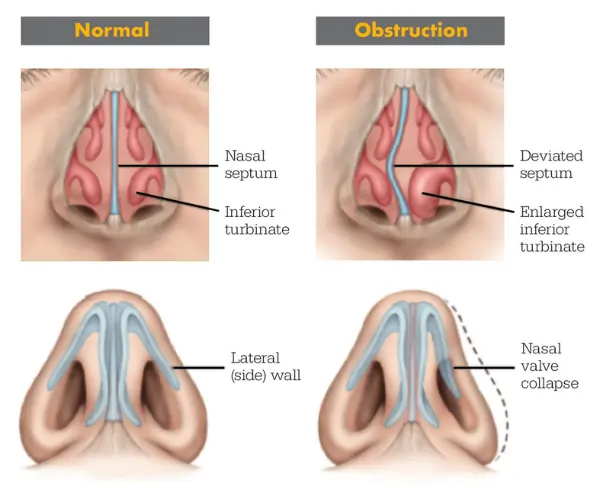 Nasal Obstruction