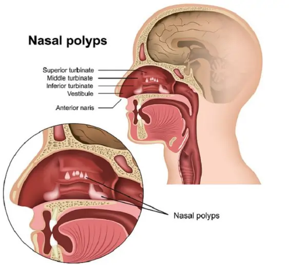 Nasal Polyps